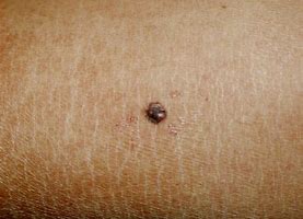 Idroclortiazide - Rischio di tumori cutanei non melanoma (carcinoma a cellule basali, carcinoma a cellule squamose).